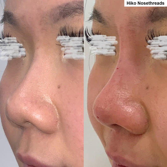 Threadlifting before and after_Lift Aesthetics Sydney