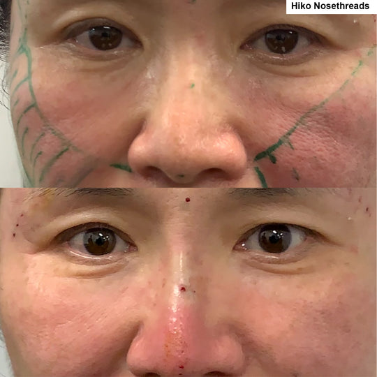 Threadlifting before and after_Lift Aesthetics Sydney