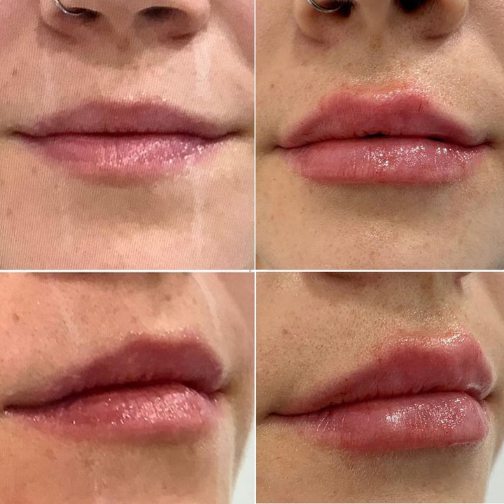 Lip filler before and after_Lift Aesthetics Sydney