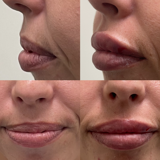 Lip filler before and after_Lift Aesthetics Sydney